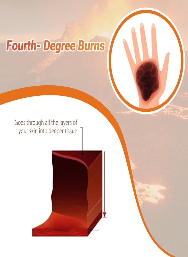MedEduQuest Burn Wound Packing Trainer, Burn Moulage, Adhesive Skin Burn Wound Trainer for Wound Care Training, Fourth Degree Burn Wound Training Model - Image 4