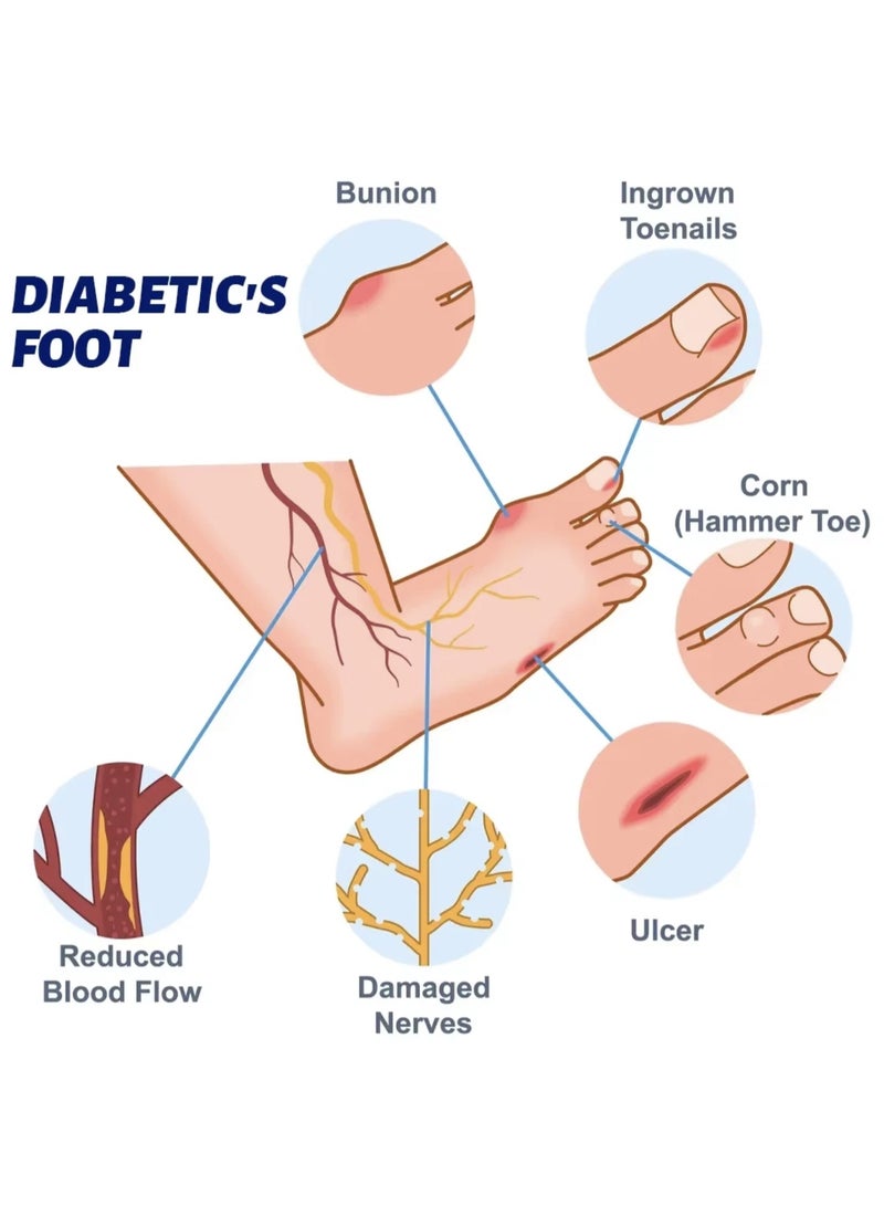 سوميفون كريم للقدم السكرية 20 جم - كريم ترطيب مكثف وإصلاح للكعب الجاف والمتشقق والمثير للحكة - Image 4