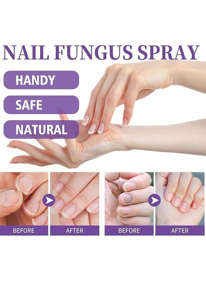 Extra Strong 100ML Toenail Fungus Treatment Spray Effective Nail Softener and Toe Nail Care Solution