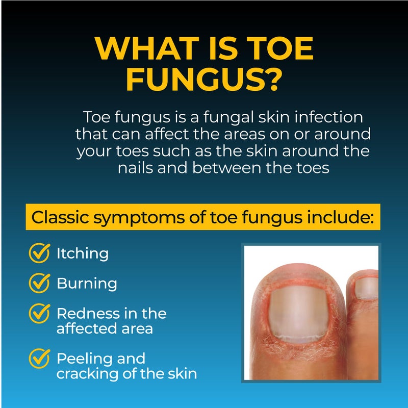 Fungi-Nail Anti-Fungal Liquid Solution, Kills Fungus That Can Lead to Nail & Athlete's Foot with Tolnaftate & Clinically Proven to Cure and Prevent Fungal Infections 1 Fl Oz (Pack of 1) - Image 4