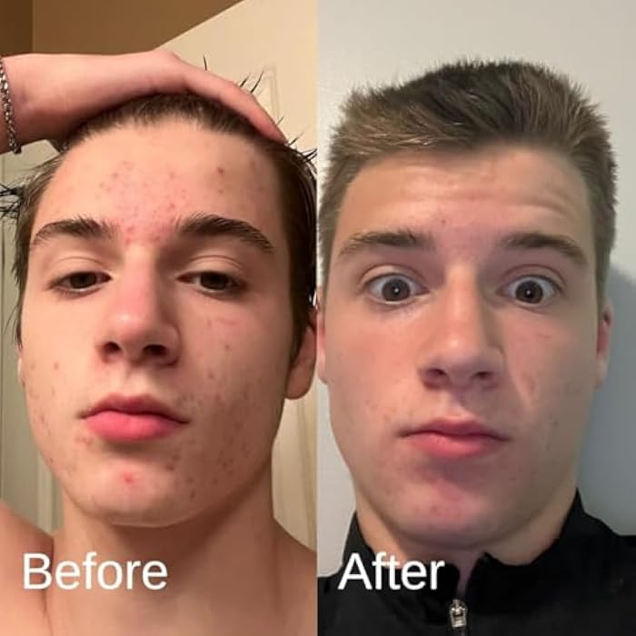 Shield Acne System for Men and Boys, Face Wash, Moisturizer, Pimple Patches, Shield Men's Skin Care Set (2 Months) - Image 3