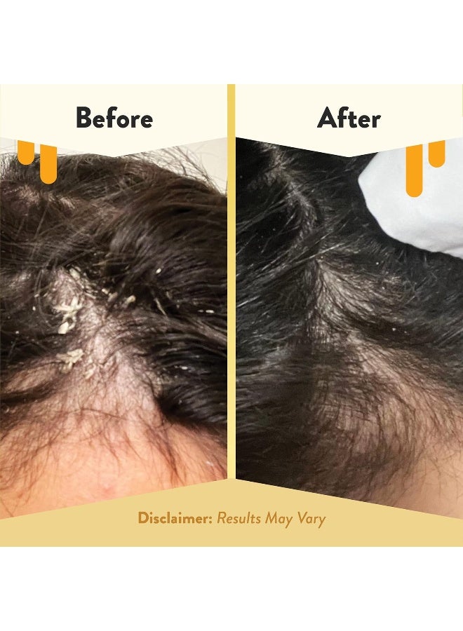 ECZEMA HONEY Soothing Scalp Oil - Natural Hair Oil & Moisturizer Helps Dandruff- Itchy & Dry Scalp Treatment - Daily Hair Care for All Hair & Skin Types (1 Oz) - Image 4