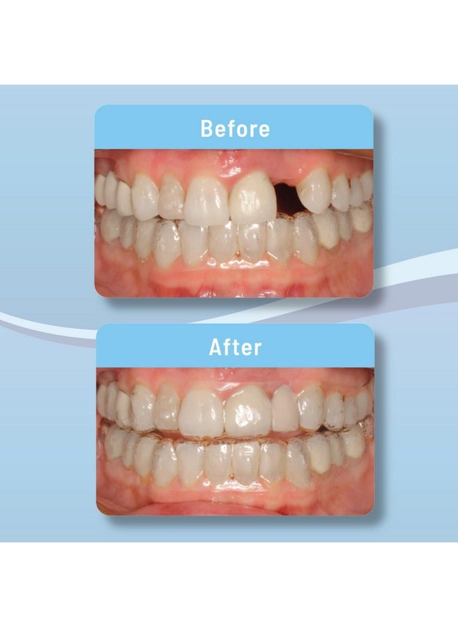 Orvance - Aligner Pontics | Temporary Tooth Replacement For Aligner Trays And Retainers During Orthodontic Treatment (16 Count) - Image 1