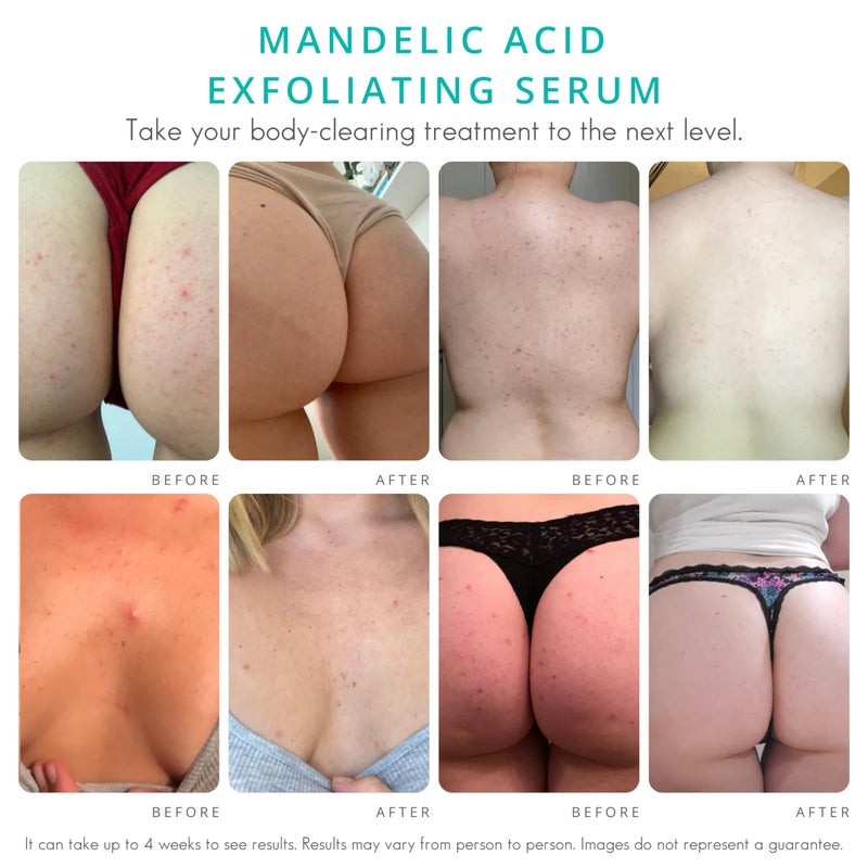 Almond Clear سيروم اللوز الواضح المستوى 2 | سيروم حمض الماندليك للجسم لعلاج حب الشباب، التهاب الجريبات الشعرية، شيخوخة الجلد، الشعر الناشئ، البقع الداكنة على الوجه، الصدر، المؤخرة، الظهر، الفخذين، الذراعين | 4 أونصات - Image 2
