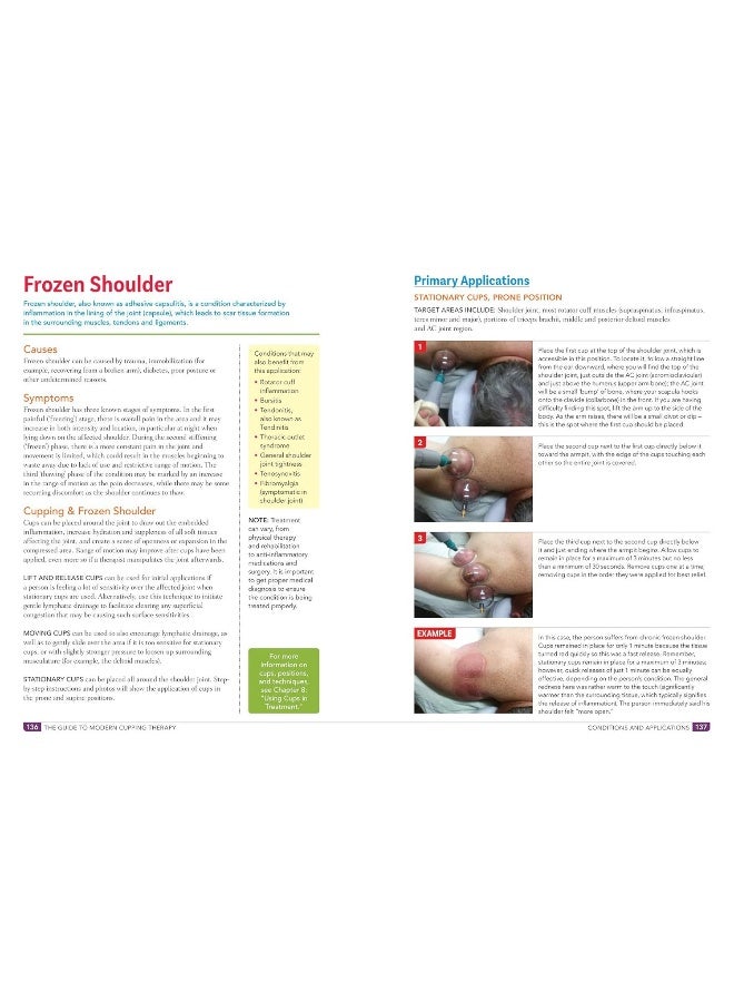 Guide to Modern Cupping Therapy: A Step-by-Step Source for Vacuum Therapy  - Image 2