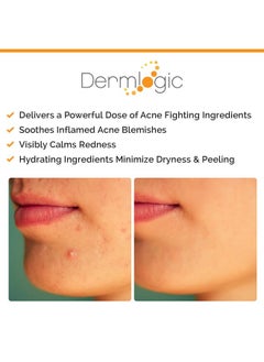 Dermlogic Acne Spot Treatment Overnight Treatment For Whitehead & Blackhead Pimples. Eliminate Cystic Breakouts & Clogged Pores. Clears Away Severe Mild Moderate Blemishes For Teens & Adults. Alcoholfree.  - Image 3