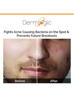 Dermlogic Acne Spot Treatment Overnight Treatment For Whitehead & Blackhead Pimples. Eliminate Cystic Breakouts & Clogged Pores. Clears Away Severe Mild Moderate Blemishes For Teens & Adults. Alcoholfree.  - Image 5