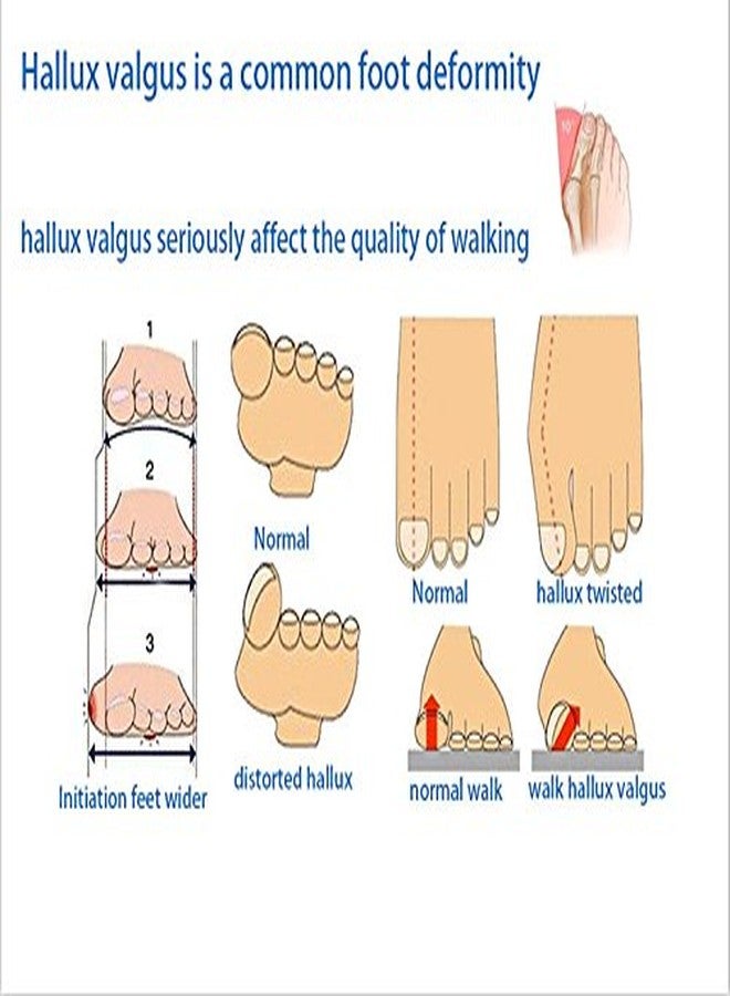 JERN Foot Care Toe Cushion, Hallux Valgus Toe Protector Gel Sleeve Toe Cushion Toe Braces Sock Metatarsal Strap (L) - Image 5