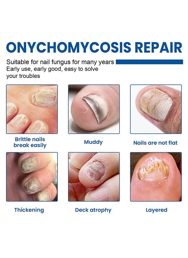 West&Month Nail Fungus Repairing Liquid-Fungal Nail Treatment for Toe Nail and Fingernails-Tea Tree Oil Nail Repair Solution for Thick/Broken/Discolored Nails-Renews Damaged Cracked Ingrown Toenail  - Image 3