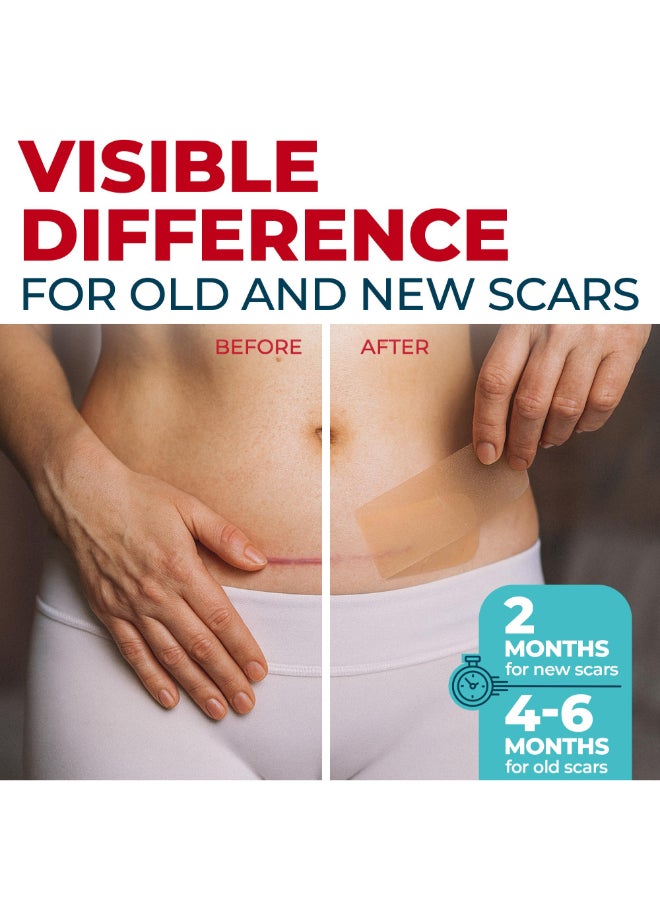 MYHELP Medical Grade Silicone Scar Sheets 6pk 57x16 Visible Difference on Surgical Keloid Marks Reusable CSection Scar Silicone Strips Easy to Use Strips - Image 4