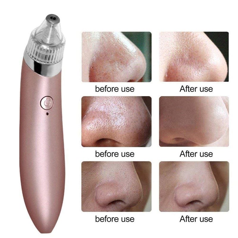 Tendula Skin Care Expert Acne Pore Cleaner Vacuum Blackhead Remover Kit Skin Cleaner Pimple Removal Tool Acne Removal Tool Blackhead Remover Tool - Image 4