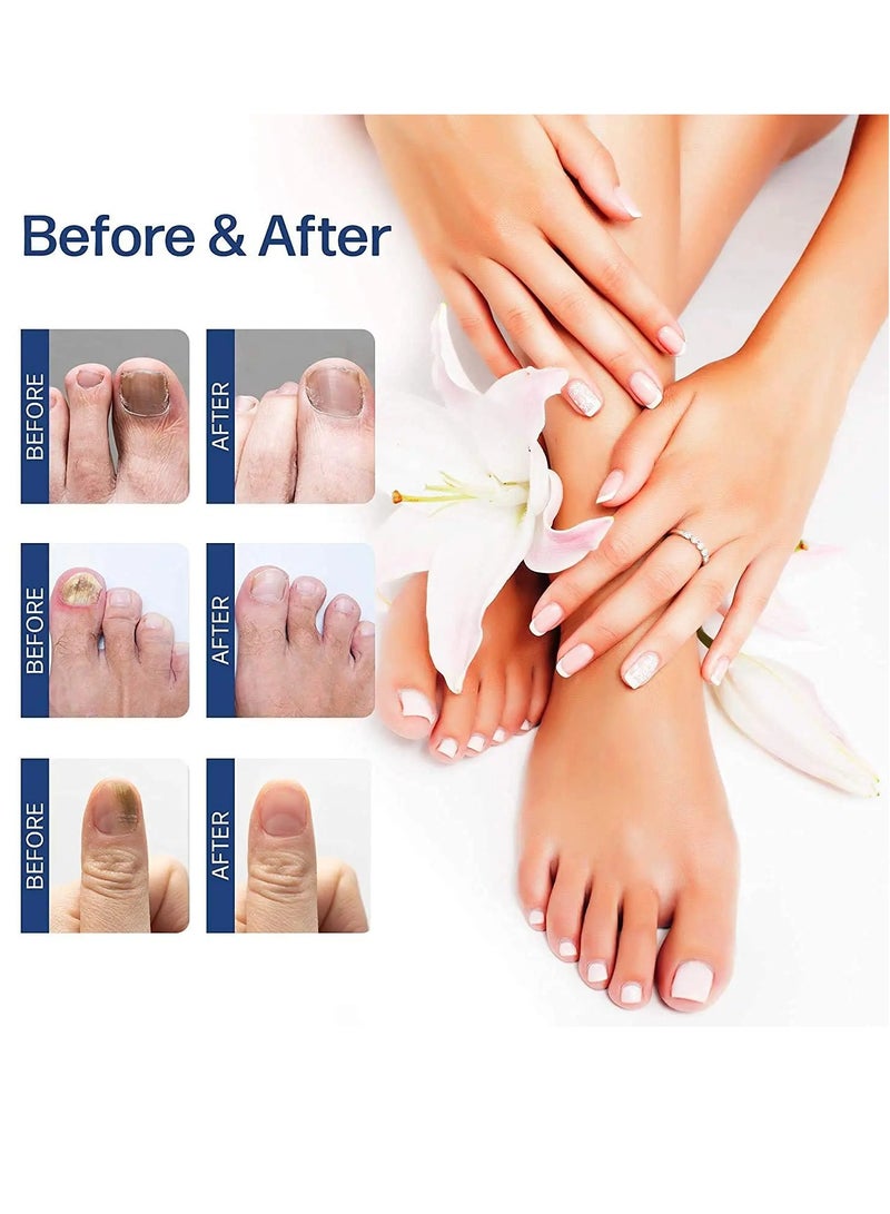 Nail Repair treatment Liquid Nail Fungus Treatment for Damaged Nails Onychomycosis Fungal Nail Renewal Anti Fungus Nail Repair Smooth Hydrates Nail Reduce Discoloration Nail Repair Essence 20ml