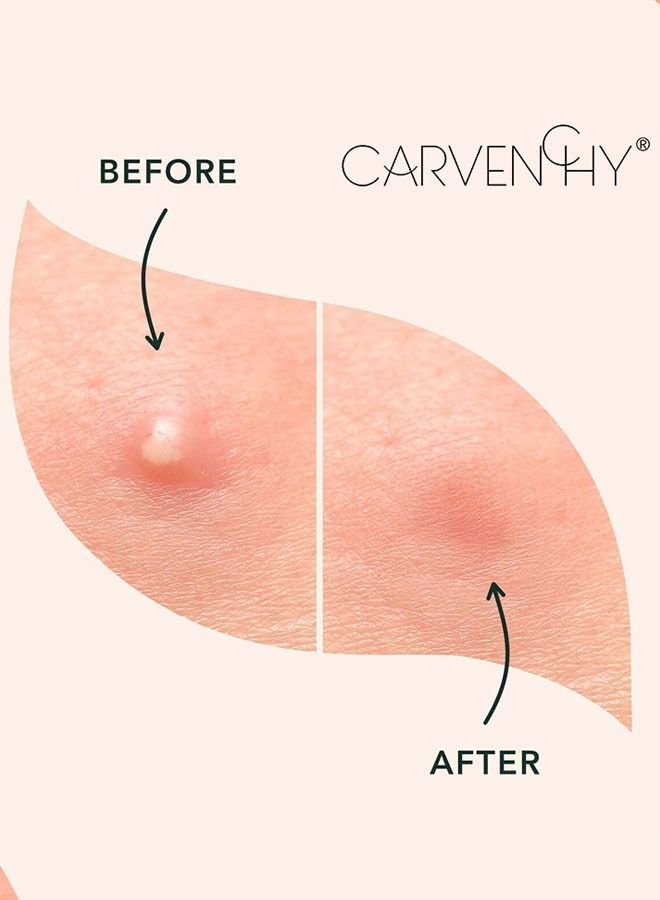 CARVENCHY Salicylic Acid Hydrocolloid Acne Patch Miracle Patch, Invisible Spot Cover, Ideal for On The Surface Spots  - Image 4
