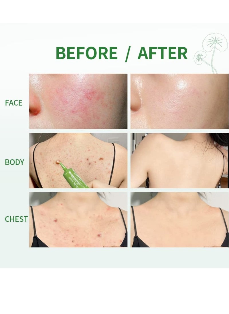 ibcccndc Acne Treatment Balm for Face Advanced Gel Acne Scar Spot Treatment for Face Gentle Skin Care for Acne Prone Skin Back Acne Treatment Shrink Pores Soothes Redness Non sticky 15g  - Image 4