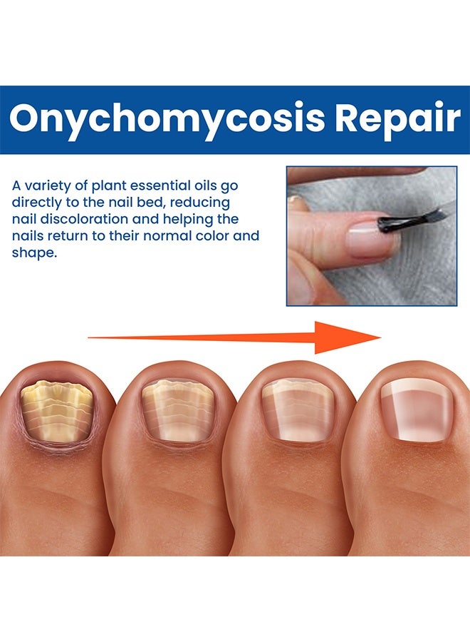 West&Month Nail Fungus Repairing Liquid-Fungal Nail Treatment for Toe Nail and Fingernails-Tea Tree Oil Nail Repair Solution for Thick/Broken/Discolored Nails-Renews Damaged Cracked Ingrown Toenail - Image 5