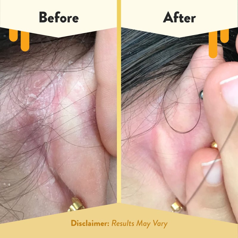 ECZEMA HONEY Gentle Face & Body Lotion Stick - Moisturizing Colloidal Oatmeal Hand Cream for Extremely Dry Skin - Eczema Lotion Helps Psoriasis, Dermatitis & More (2.2 Oz) - Image 4