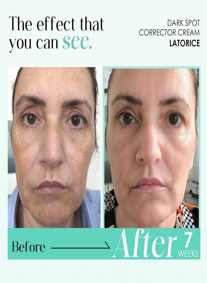 LATORICE Dark Spot Remover for Face and Body: Tranexamic Acid Serum for Women and Men - Reduce Sun Spot Melasma Freckles (1.7 Fl Oz - Image 4