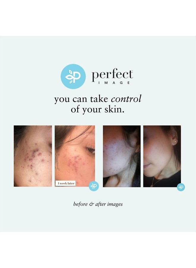 PERFECT IMAGE - Salicylic 20% Gel Peel, Breakout and Pore Minimizer and Cleanser, Strength Level 2, 15-30 Full Facial Chemical Peels, 1 fl oz. e, 30 ml - Image 1