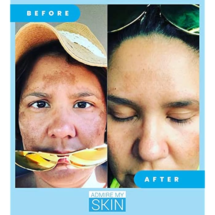 Admire My Skin Dark Spot Corrector Remover for Face - Brightening Discoloration Correcting Serum - Kojic Acid + Azelaic Acid Serum for Melasma and Sun Spots 1oz - Image 5