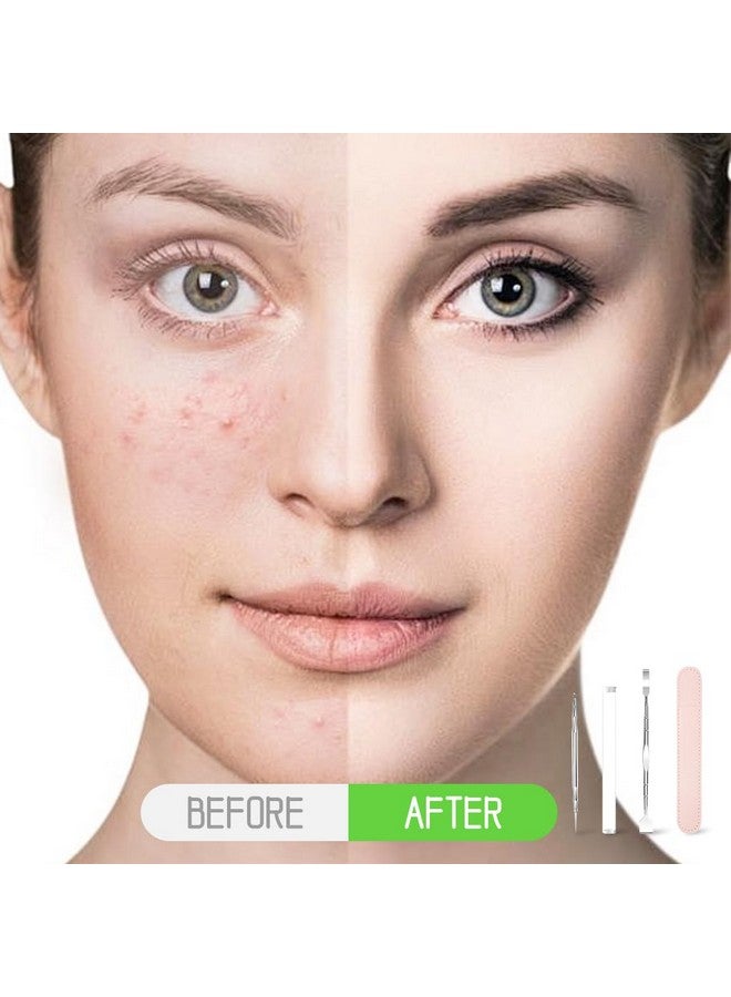 maycreate ® Pimple Remover Tool Black Heads Remover Kit, Stainless Steel Comedone Extractor & Dual Head Blackhead Removal Shovel Facial Pore Cleaning Tools For Acne, White Heads Popping - Image 5