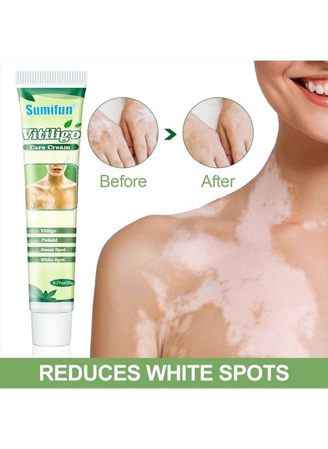 Sumifun - Vitiligo Cream, Vitiligo Care Cream for Skin Vitiligo, Psoriasis, Leukoplakia - Reduces White Spots on Skin, Pigmentation regulating and Improve Skin Pigmentation - 6 Counts - Image 1