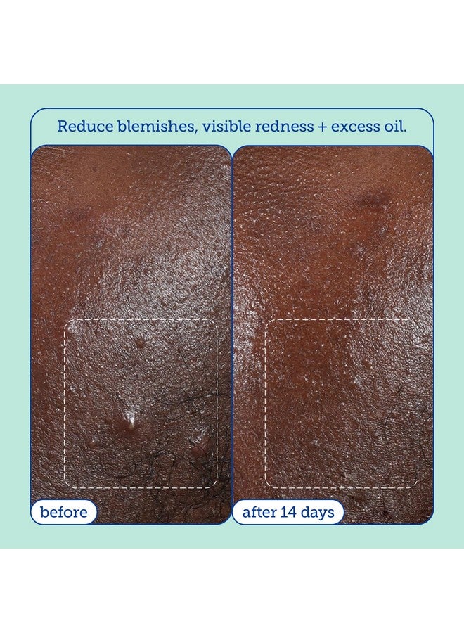 Skinfix Skinfix Acne+ BHA Cleanser: Multi-Level Pore Resurfacing, Deep Pore & Acne-Fighting Cleanser Helps Reduce Blemish Size, Redness & Excess Oil, 5 Fl Oz  - Image 3