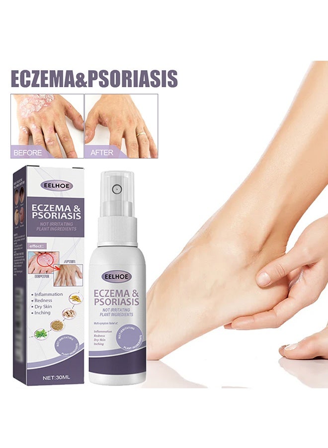 EELHOE Eczema and Psoriasis Non-Steroidal 100% Natural Relief，Atomizing Spray 30ml, Hand and Foot Moss Skin Repair, Relieve Itching, Skin care and Jiejia spray, Antibacterialnot Irritating Safety - Image 1