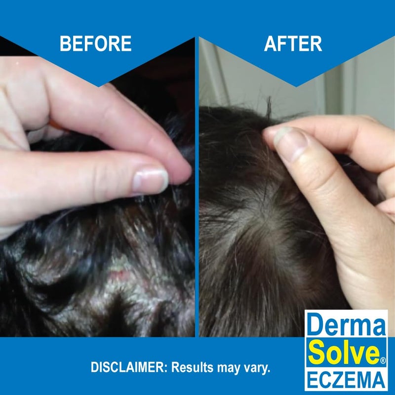 Dermasolve Eczema Shampoo & Conditioner (Combo Pack) - Flare Control Scalp & flake Relief Therapy that Protects, Moisturizes, and Repairs Skin by DermaSolve - Kids & Adults - Steroid Free - Image 3