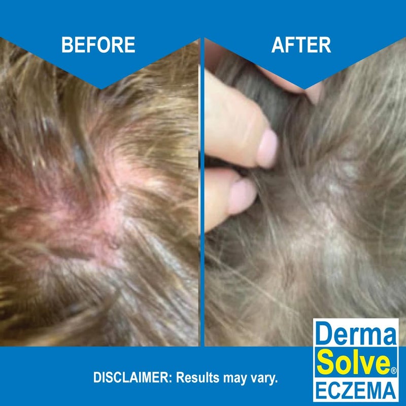 Dermasolve Eczema Shampoo & Conditioner (Combo Pack) - Flare Control Scalp & flake Relief Therapy that Protects, Moisturizes, and Repairs Skin by DermaSolve - Kids & Adults - Steroid Free - Image 5