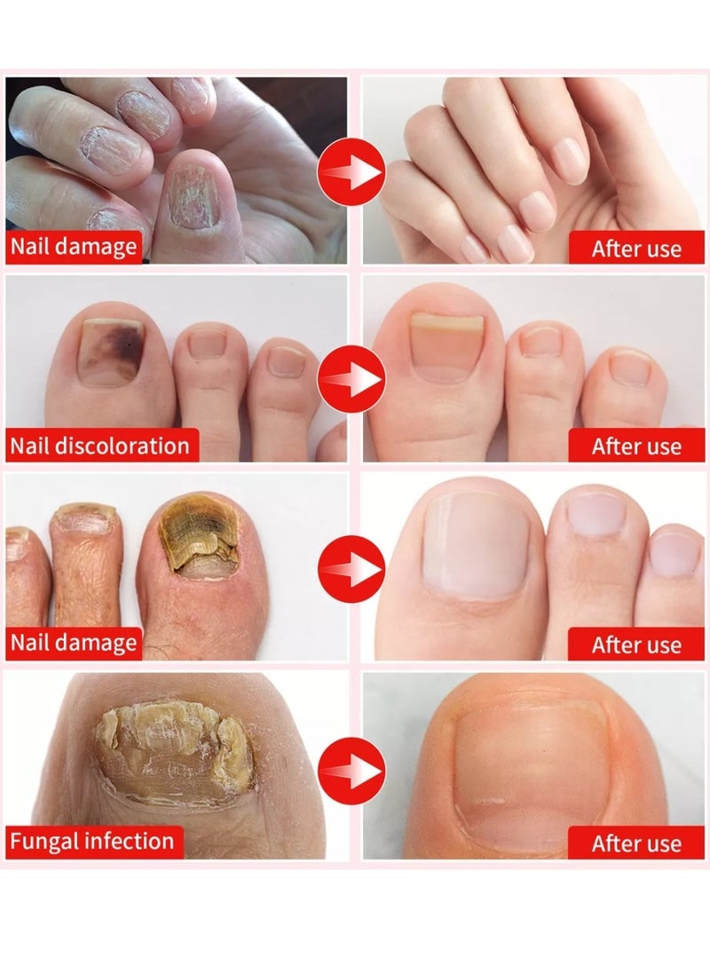 DERMFREE - Fungi Nail Triple Action Formula Treatment Liquid Toenail and Fingernails Fungus Removal Serum Stop Itching Burning and Athletes Foot Treatment Serum Restore Healthy Nails Fungal Nail Liquid 15ml - Image 1