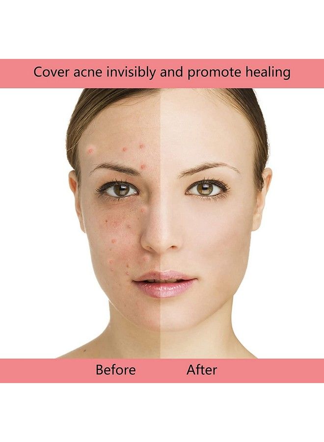 Spanking Dots For Spots Pimple Patches(216 Patches) Acne Pimple Hydrocolloid Patches 0.05Mm Ultrathin Breathable Invisible Blemish Spot Three Sizes Acne Treatment For Face Care  - Image 4