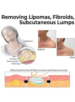 SOUTH MOON Lipoma Removal Cream 20g, Lipoma Removal Cream Ointment, Lipoma Elimination Cream, Get Rid of Your Fatty Lipoma Lumps  - Image 4