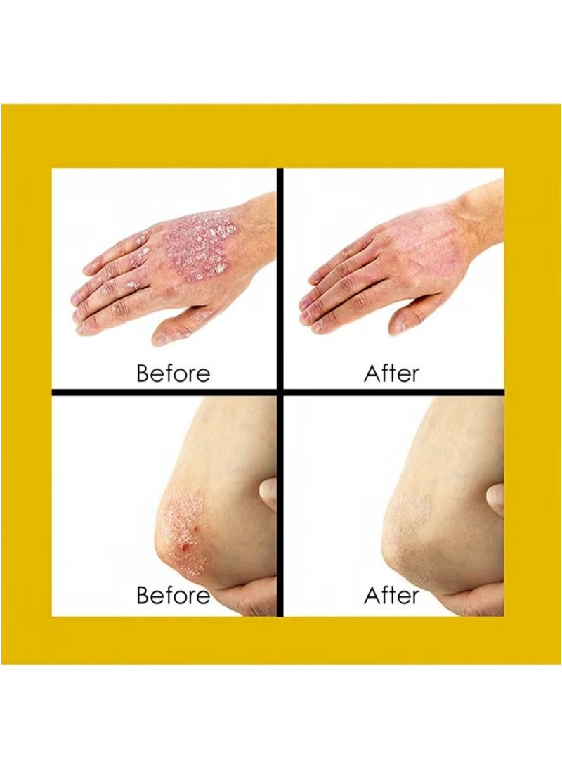 سوميفون كريم الصدفية، مناسب لمختلف الظروف الجلدية مثل الصدفية، الأكزيما، التهاب الجلد، والحكة. - Image 4