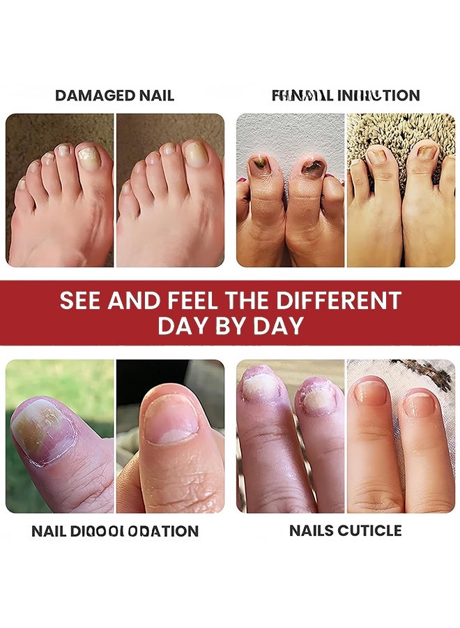 DERMFREE Nail Toenail Cream，Nail Repair Cream, 20g Nail Cream Anti Harmful Substance Repair Finger Toe Nail Care Perfect for Men and Women Home Use - Image 2