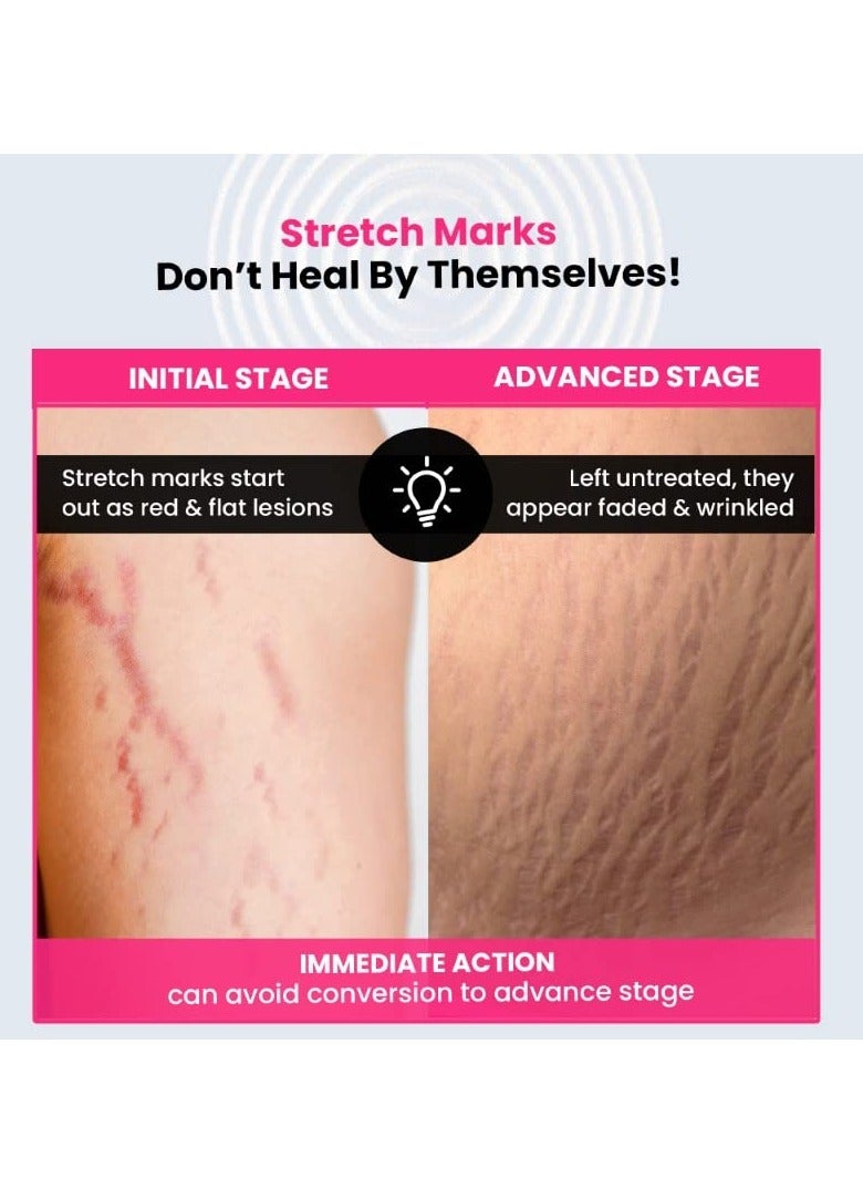 ThriveCo Stretch Marks Expert Serum Cream | Prevents & Reduces Appearance of New (Red) and Old (White) Stretchmarks | Powered by Striover™, Rosehip Oil & Squalane | Vegan and Cruelty-free | For Men & Women | 30ml (Pack of 2) - Image 3