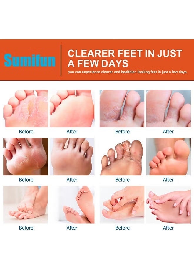 Sumifun Athlete's foot spray, antifungal treatment for itchy, sweaty, peeling, and blistering feet, natural ingredients, athlete's foot spray for tinea pedis, 30ml - Image 2