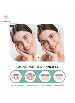 Skinside Acne Pimple Patches For Face Pimples | Hydrocolloid Facial Spot Patches With 0.5% Salicylic Acid For Pimple Healing | Invisible Waterproof Absorbs Excess Oil & Pimple Overnight (36 Patches)  - Image 4