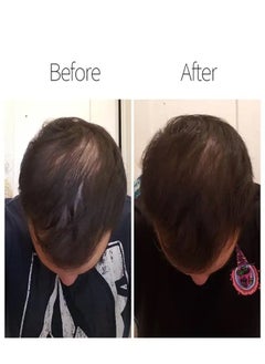 BUNEE Minoxidil and Biotin Enriched Hair Regrowth Foam, Combating Hair Loss with 5% Minoxidil Power, Boosted by Ginseng Extract for Accelerated Scalp Growth, 60ml.  - Image 3