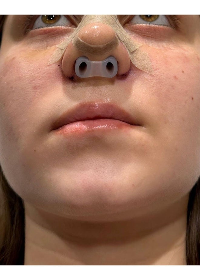 Nostril Retainer | Nostril Retainer for Rhinoplasty Recovery | Nose Retainer for Surgery | Nose Shaper & Support Device | High-Grade Silicone | Post-Surgery Nostril Shaping & Recovery Aid - Image 3