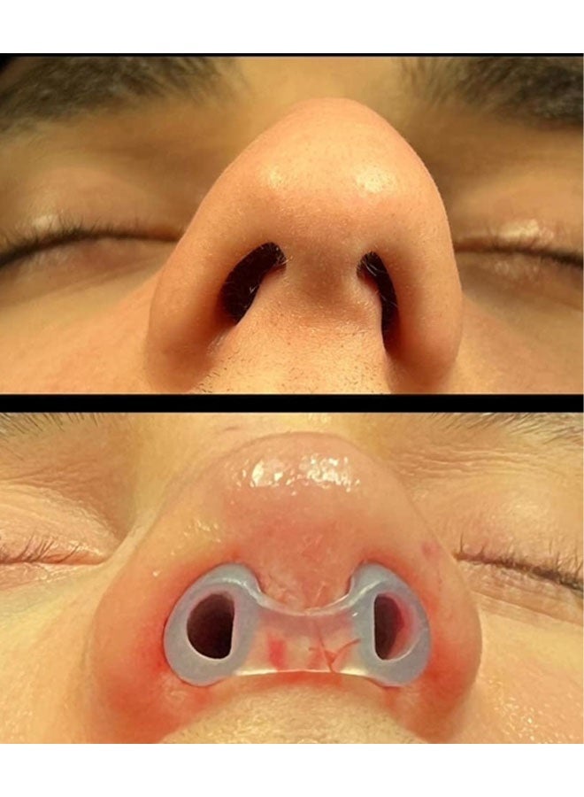Nostril Retainer | Nostril Retainer for Rhinoplasty Recovery | Nose Retainer for Surgery | Nose Shaper & Support Device | High-Grade Silicone | Post-Surgery Nostril Shaping & Recovery Aid - Image 5