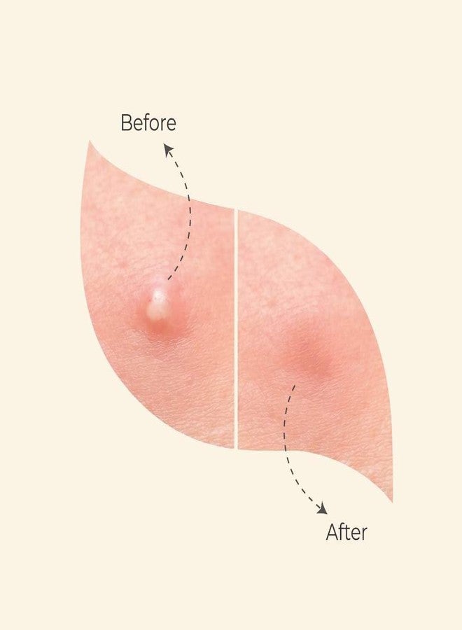 Perr Cherry Pimple Patch | 40 Hydrocolloid Patches | Absorbs Oil, Prevents Scarring | For All Skin Types | Acne Patches for Face (Pink & Yellow, 80) - Image 3