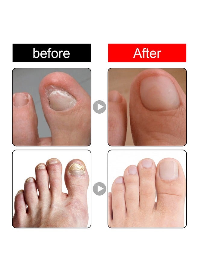 SOUTH MOON Ingrown Toenail Drops,Soften Nail & Straighten Nails，Easy Trim Ingrown Toenail Tools,Ingrown Toenail Reliever and Softener 30ML - Image 3