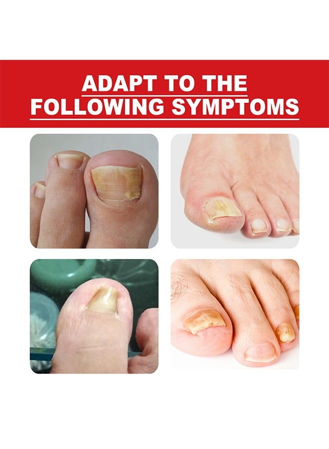 SOUTH MOON Ingrown Toenail Drops,Soften Nail & Straighten Nails，Easy Trim Ingrown Toenail Tools,Ingrown Toenail Reliever and Softener 30ML - Image 4