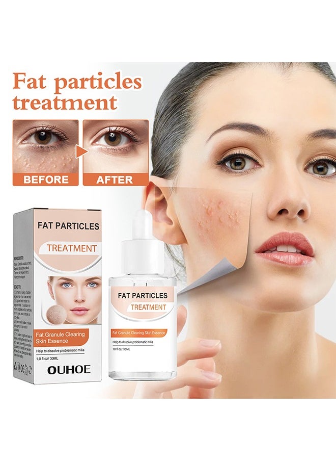 OUHOE - Fat Granule Clearing Skin Essence-Milia Removal Treatment, Milia Spot Treatment Helps Dissolve And Reduce Milia, Whitehead And Sebaceous Hyperplasia, Cysts And Sebaceous Hyperplasia Face Serum 30ml - Image 1
