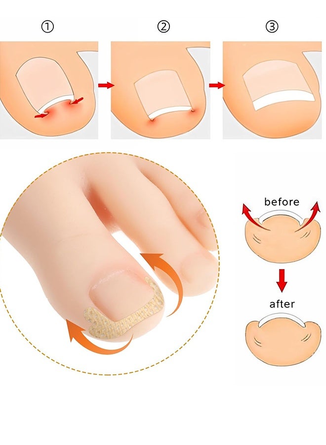 60pcs Ingrown Toenail Corrector Patch and 50pcs Ingrown Toenail Strips Breathable Ingrown Toenail Stickers Tape for Toenail Treatment Pain Relief and Correction - Image 3