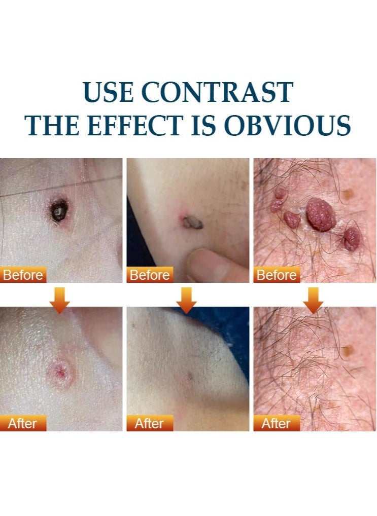 Wart Removal Cream,  Wart Remover for Genital Warts, Plantar Warts, Common Warts, Corns, Wart Cream 20g - Image 5