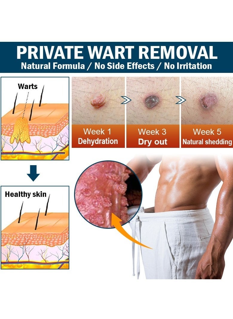 Wart Removal Cream,  Wart Remover for Genital Warts, Plantar Warts, Common Warts, Corns, Wart Cream 20g - Image 3