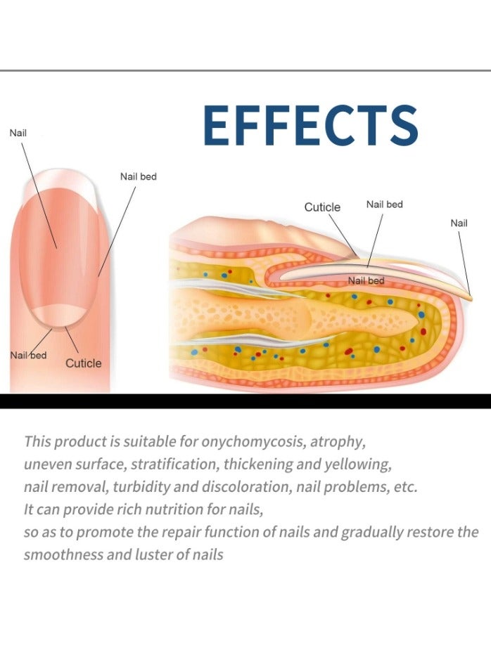EELHOE 32Pcs Fungal Nail Patches Overnight Nail Repair Patch for Nail Fungus Damage Nail Treatment Renews Nails Structure and Improve Discoloration 8Hrs Nighttime Renewal Fungal Nail Patch - Image 5