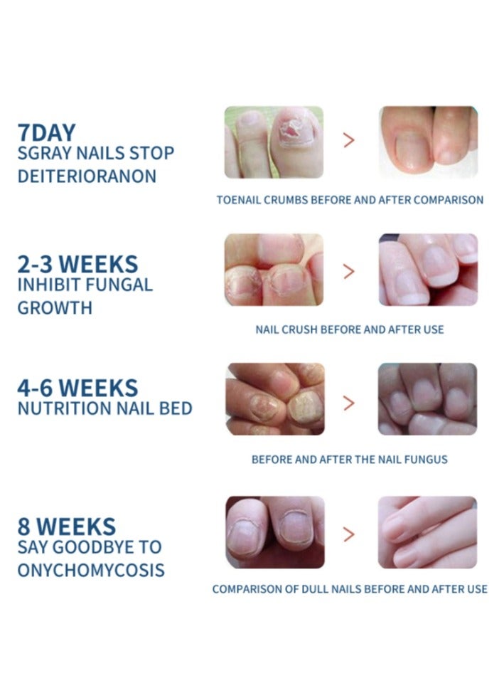 EELHOE 32Pcs Fungal Nail Patches Overnight Nail Repair Patch for Nail Fungus Damage Nail Treatment Renews Nails Structure and Improve Discoloration 8Hrs Nighttime Renewal Fungal Nail Patch - Image 3