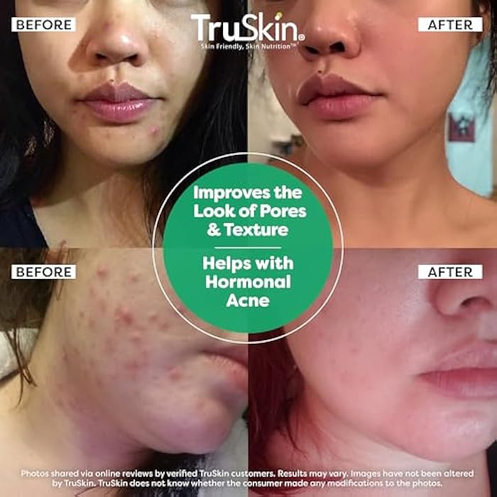 TruSkin Tea Tree Oil Acne Treatment for Face – Acne Serum – Improve the Appearance of Pores, Skin Tone for Smooth, Glowing Skin with Salicylic Acid, Vitamin C, Niacinamide & Retinol, 1 fl oz - Image 4